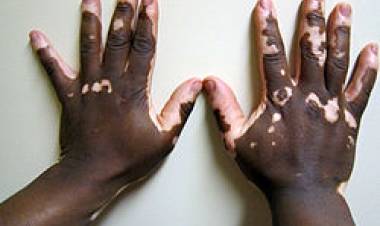 25 DE JUNIO: DIA MUNDIAL DEL VITILIGO