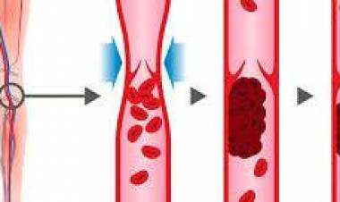 13 SE OCTUBRE: DIA MUNDIAL DE LA TROMBOSIS
