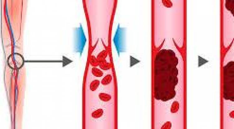 13 SE OCTUBRE: DIA MUNDIAL DE LA TROMBOSIS