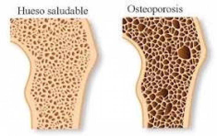 20 DE OCTUBRE: DIA MUNDIAL DE LA OSTEOPOROSIS